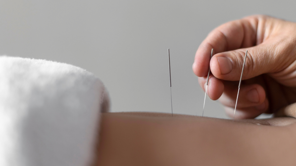 What Does Dry Needling Actually Feel Like? A Patient's Guide